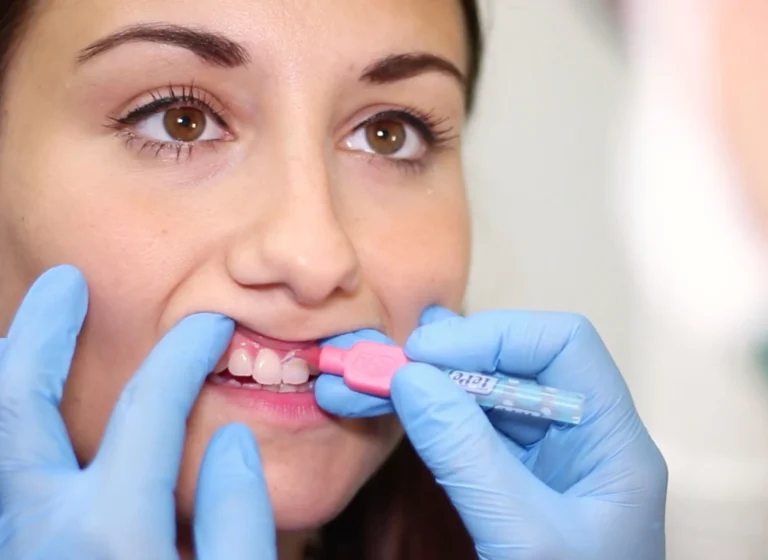 dopo quanti anni bisogna sostituire le faccette dentali