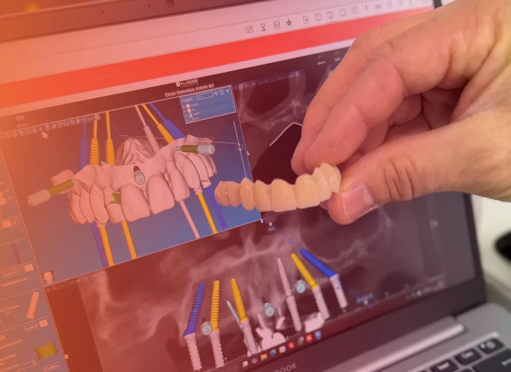 Implantologia 1 impianto dentale a Abbiategrasso e Pavia